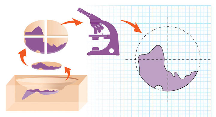 Mohs surgery cycle