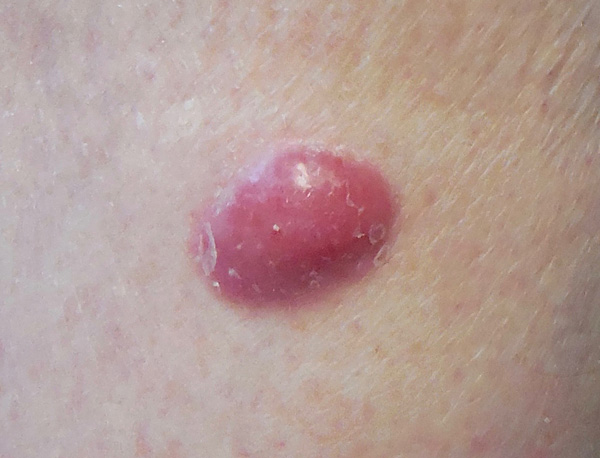 merkel cell carcinoma on lower leg