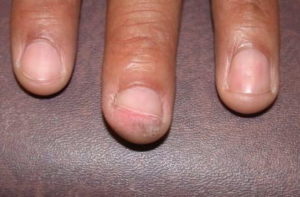 Bowen’s disease of the finger