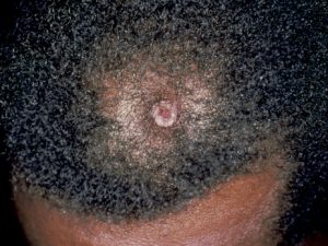 CSCC on the scalp of a Black man