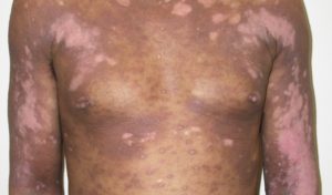 Hypopigmented cutaneous T-cell lymphoma (CTCL)