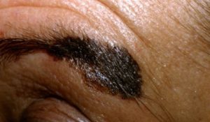 Melanoma on the eyebrow of a Hispanic man