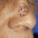 Morpheaform BCC on a Black woman’s face