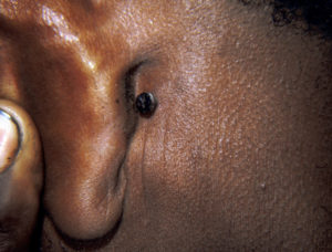 Pigmented BCC behind the ear